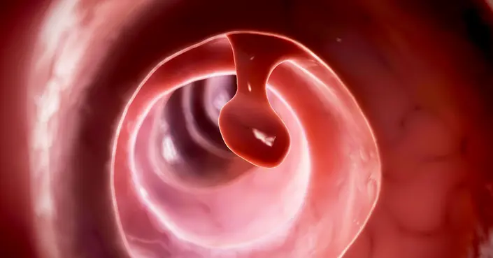 اكتشف خبايا سلائل القولون: الأسباب، الأعراض، والوقاية من مضاعفاتها الخطيرة