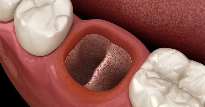 التهاب السنخ الجاف: دليلك الشامل للوقاية والعلاج الفعال