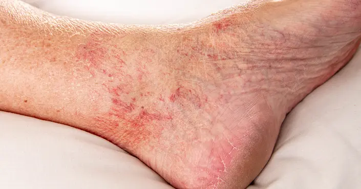 الخطوط الحمراء في الجسم: دليل شامل لأسبابها، علاجها، والوقاية منها
