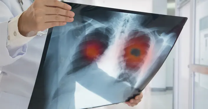 تشخيص سرطان الرئة وعلاجه: دليل شامل للوقاية والعلاج الفعال