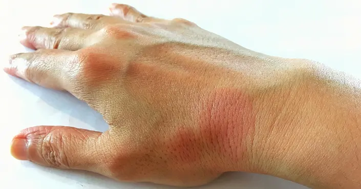 الحمى الذؤابية: دليلك الكامل لمرض الذئبة وأعراضه وعلاجه الفعال