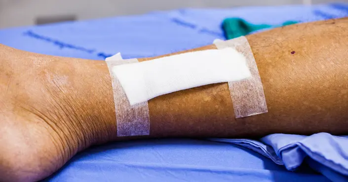 طرق علاج التهاب الحروق الفعالة: دليل شامل للتعافي السريع