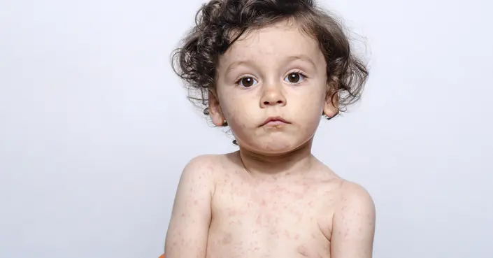 الفرق بين الحصبة والحصبة الألمانية: دليل شامل للفهم والوقاية