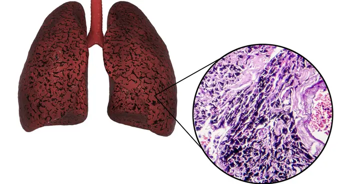 رئة المدخن: دليل شامل لأمراض وحالات صحية خطيرة يجب أن تعرفها