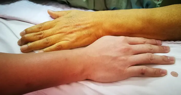 أسباب اصفرار الجسم: دليل شامل لفهم اليرقان وعلاماته