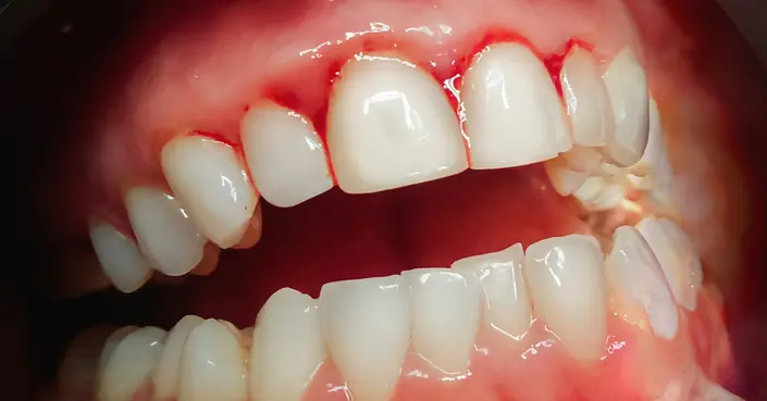 نزيف اللثة ليلًا: دليل شامل للأسباب، الأعراض، والعلاج الفوري