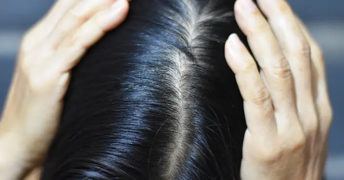 الفروة الدهنية: دليلك الشامل للتخلص من الزيوت الزائدة وشعر صحي