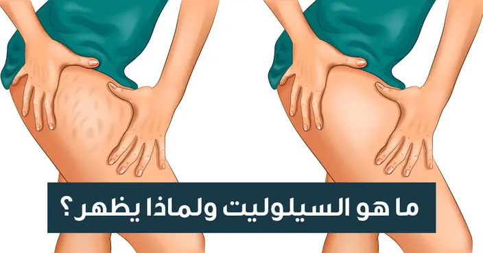 ما هو السليوليت حقًا؟ دليلك الشامل لفهم الأسباب والعلاج الفعال