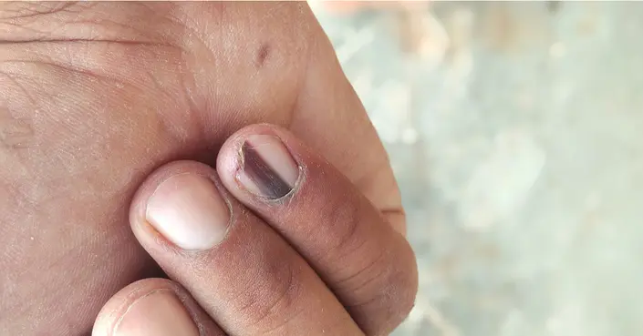 خطوط سوداء على الأظافر: اكتشف الأسباب ومتى يجب القلق