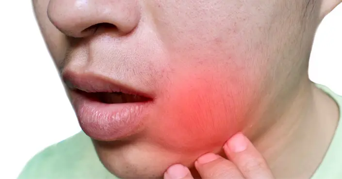 لماذا ينتفخ وجهك فجأة؟ دليلك الشامل لأسباب انتفاخ الوجه المفاجئ وطرق التخفيف منه