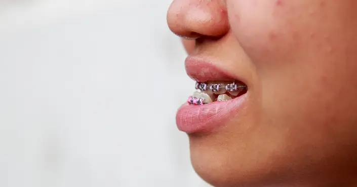 تقدم الفك السفلي: دليل شامل لأسبابه، تشخيصه، وطرق العلاج