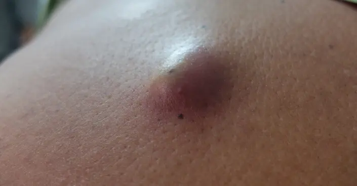 هل الكيس الدهني خطير حقًا؟ دليل شامل لفهم الأكياس الدهنية ومخاطرها