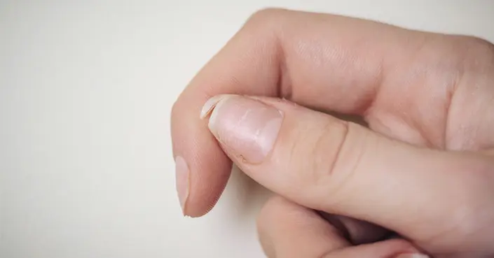 تخلص من تقصف الأظافر: الأسباب، العلاج، والوقاية لأظافر أقوى وأجمل