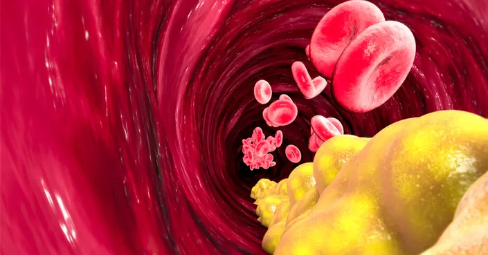 الدهون الثلاثية المرتفعة: تعرف على تأثيرها الخطير على صحتك وكيف تحمي نفسك