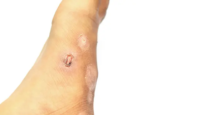 علاج الجرب بالكبريت: دليل شامل لفعاليته، استخدامه، وتحذيراته