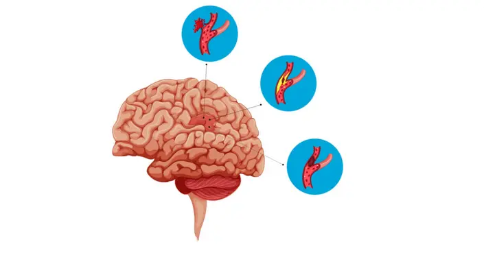 تمدد الأوعية الدموية في الدماغ: دليلك الشامل للوقاية والعلاج