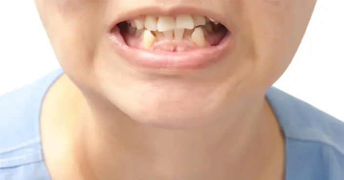 تخلص من ازدحام الأسنان: أسباب، أعراض، وحلول فعالة لابتسامة مثالية