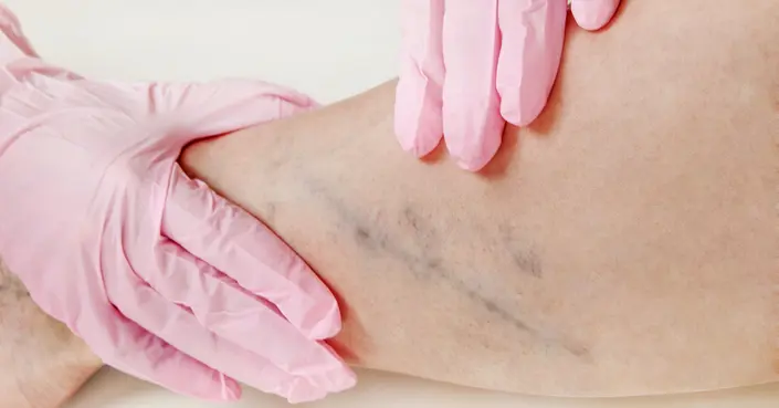 فترة علاج جلطة الساق: دليل شامل للمدة، الرعاية، والوقاية