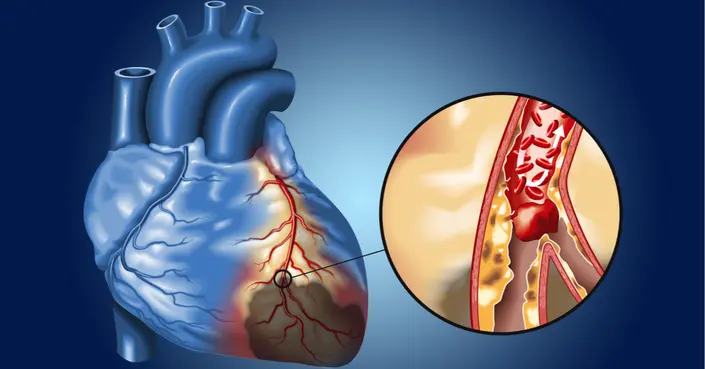 خطورة انسداد شرايين القلب: الأسباب، الأعراض واستراتيجيات الوقاية