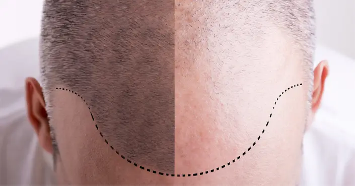 أنواع زراعة الشعر: دليل شامل لأحدث التقنيات ونتائجها