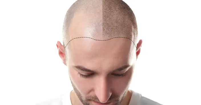 دليل شامل: الممنوعات بعد زراعة الشعر لضمان أفضل النتائج