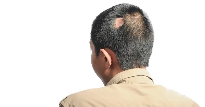 الصلع الندبي: دليلك الشامل لفهم الثعلبة الندبية وأسبابها وعلاجها