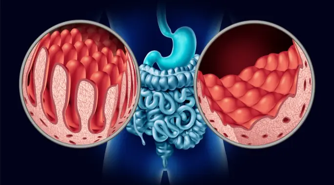 هل مرض السيلياك يسبب السرطان؟ فهم العلاقة بينهما والمخاطر الحقيقية
