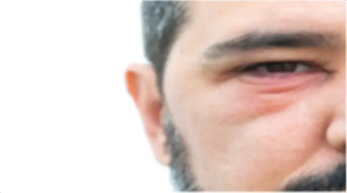 احمرار تحت العين: الأسباب، العلاج، ومتى يجب القلق؟