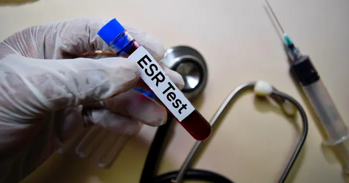 تحليل ESR والسرطان: دليلك الشامل لفهم العلاقة وأهمية النتائج