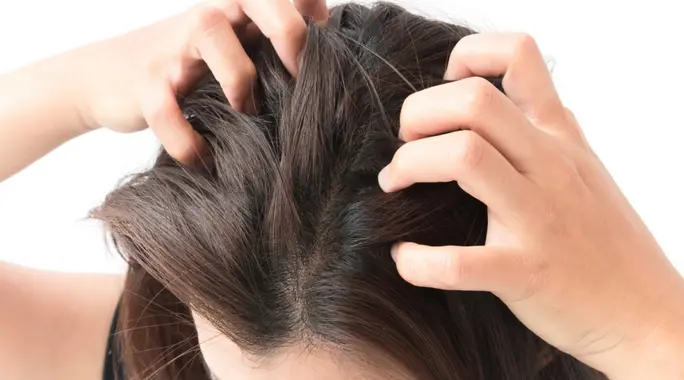 وداعًا للحكة! دليلك الشامل لـ علاج حكة الرأس الشديدة طبيعيًا وطبيًا