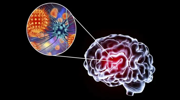 هل التهاب الدماغ خطير؟ دليلك لفهم المخاطر وطرق الوقاية والعلاج