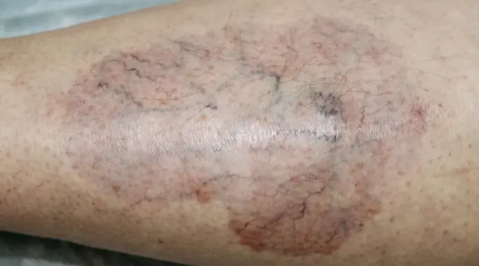 البلى الحيوي الشحماني السكري: دليل شامل لفهم، تشخيص، وعلاج هذه الحالة الجلدية النادرة