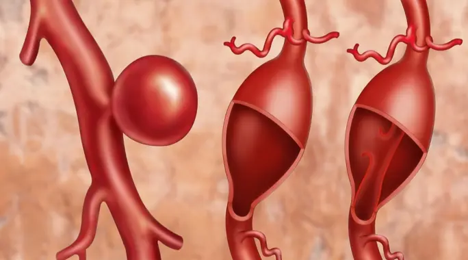 أم الدم الدماغية: دليل شامل لأعراضها، أسبابها، وتشخيصها وعلاجها