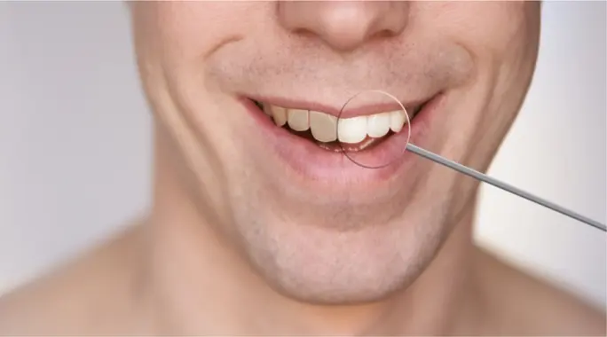 لماذا يتغير لون السن بعد سحب العصب؟ دليلك الشامل للعلاج والوقاية