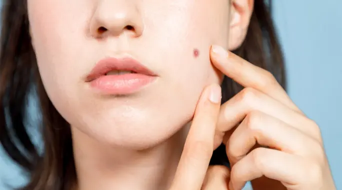 لماذا تظهر شامات صغيرة في وجهك؟ دليلك الشامل لأسباب وعلاج شامات الوجه