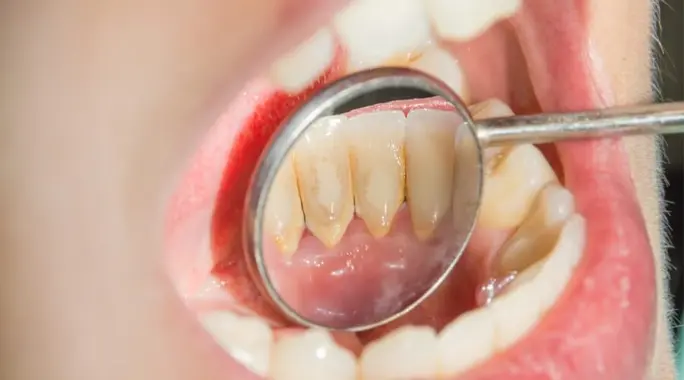 أضرار جير الأسنان: دليل شامل لمخاطر صحة فمك وجسمك