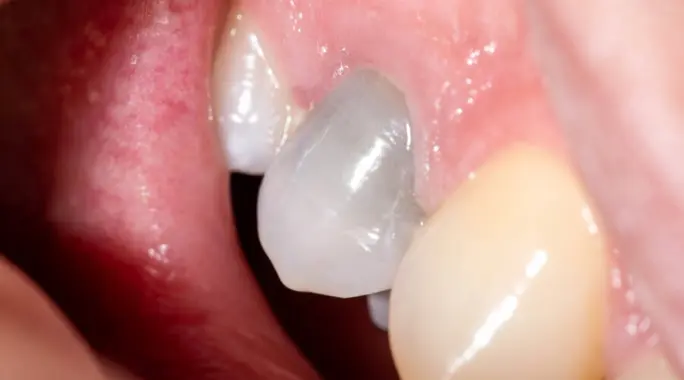 موت عصب السن: دليل شامل لفهم الأسباب، الأعراض، والعلاج الفعال