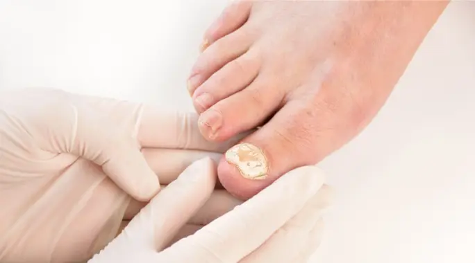 علاج فطريات الأظافر لمرضى السكري وكيفية الوقاية منها: دليل شامل