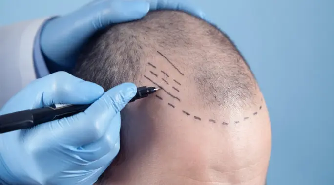 مخاطر زراعة الشعر: كل ما تحتاج معرفته قبل اتخاذ القرار
