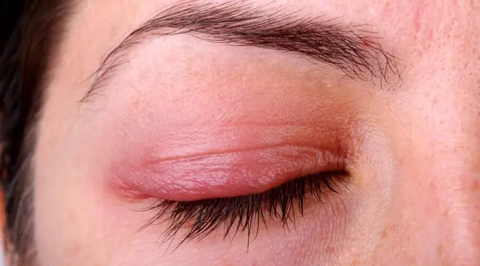 علاج التهاب الجفون في المنزل: 7 طرق فعالة للتخفيف من الانزعاج