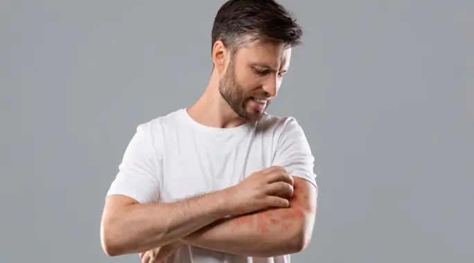 كيفية علاج العدوى البكتيرية الجلدية: الطرق الطبية والمنزلية الفعّالة