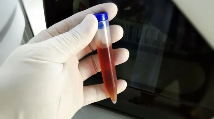 نسبة الدم في البول الطبيعية: متى يكون وجوده آمناً ومتى يجب أن تقلق؟