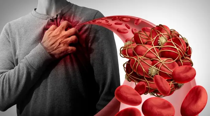 كيف تحمي نفسك من الجلطات الدموية؟ دليل شامل للوقاية الفعّالة