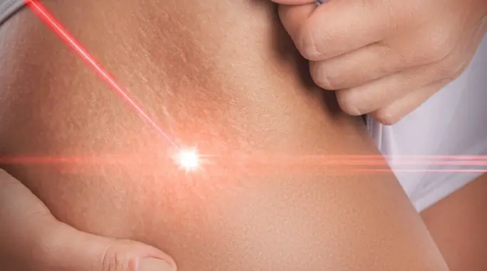 Laser Cellulite Treatment: Your Ultimate Guide to Smoother Skin