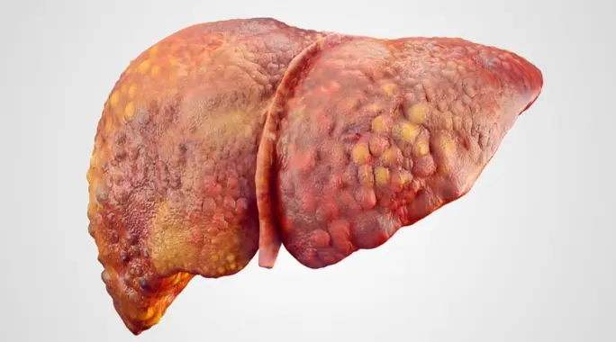 تشمع الكبد: دليل شامل لأنواعه المختلفة وأهم المعلومات