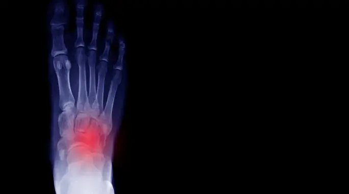 بروز العظم الزورقي في القدم: الأسباب، الأعراض، وطرق العلاج الشاملة