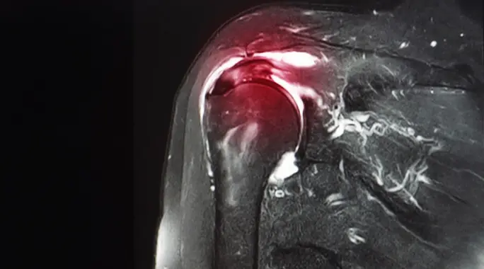 تمزق أربطة الكتف: دليلك الشامل للعلاج، الأعراض، والأسباب