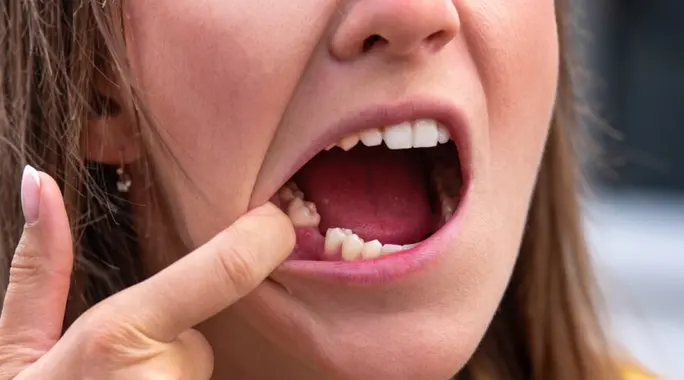 متى تلتئم اللثة بعد خلع الضرس؟ دليل شامل لسرعة التعافي
