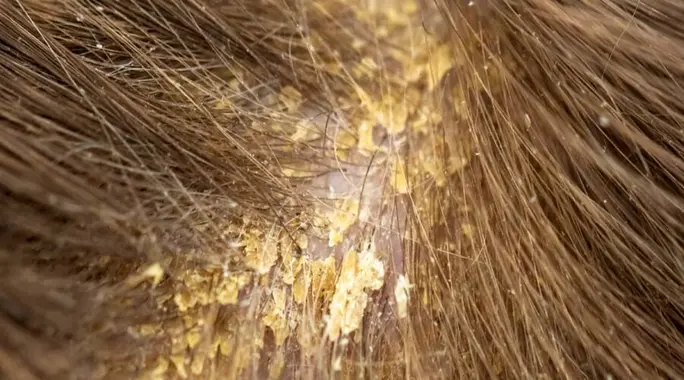 وداعًا للقشرة السميكة: أسبابها، أعراضها وطرق علاجها الفعّالة لفروة رأس صحية