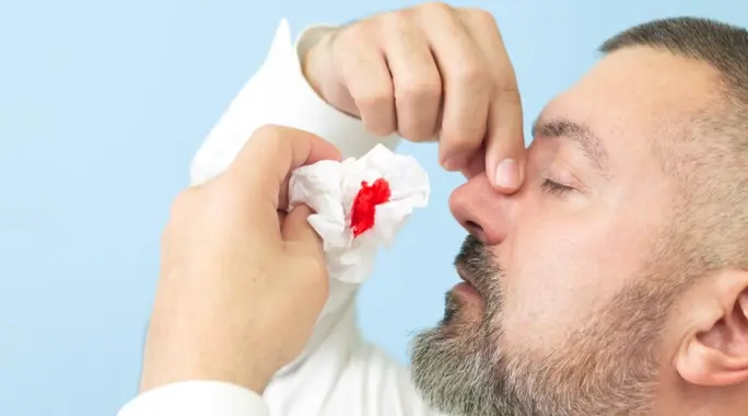 دليل شامل: كيف توقف نزيف الأنف بفعالية وتعرف متى يجب مراجعة الطبيب